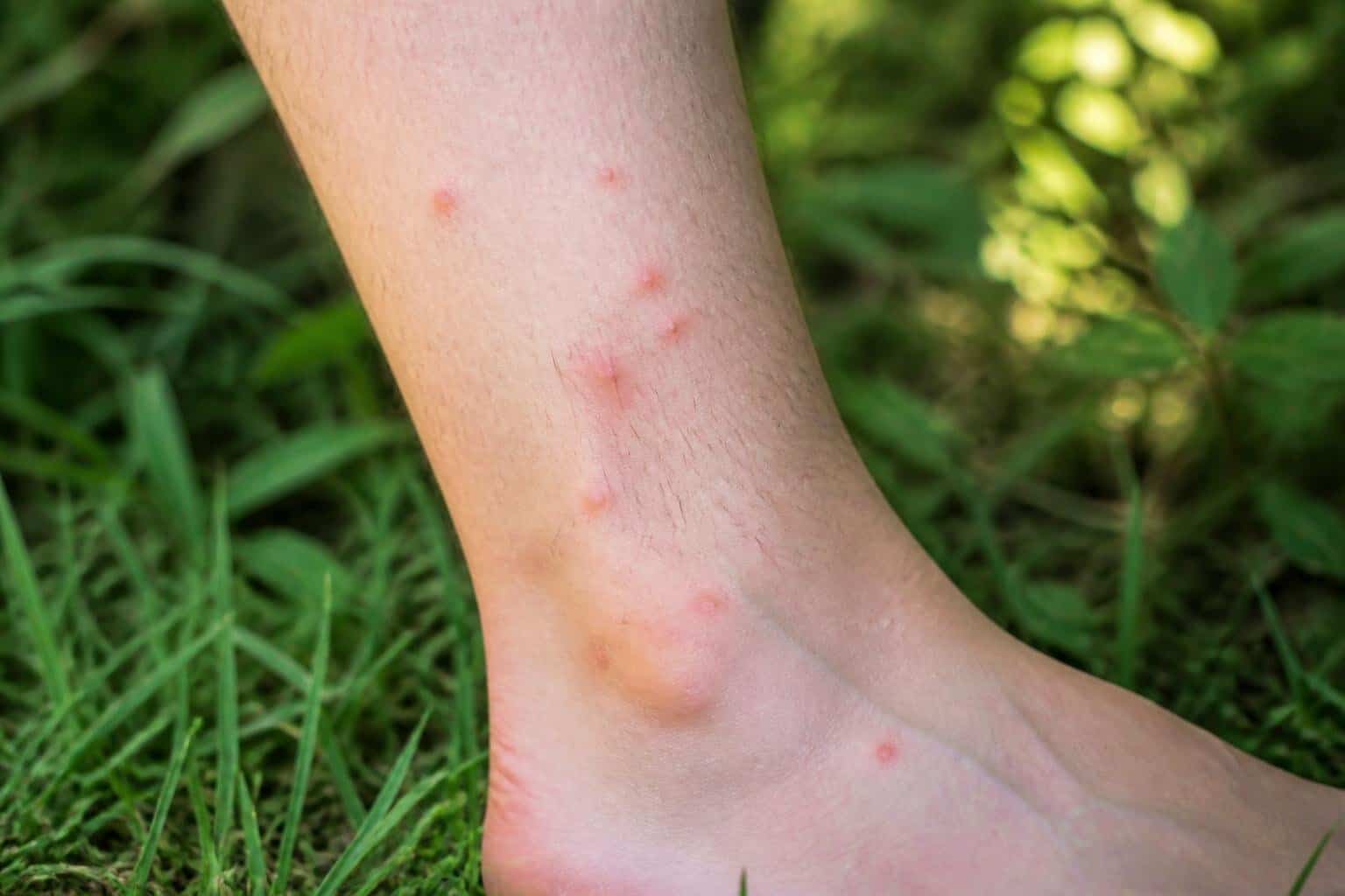 Close-up of a person's lower leg with small red chigger bites outdoors in a grassy area.