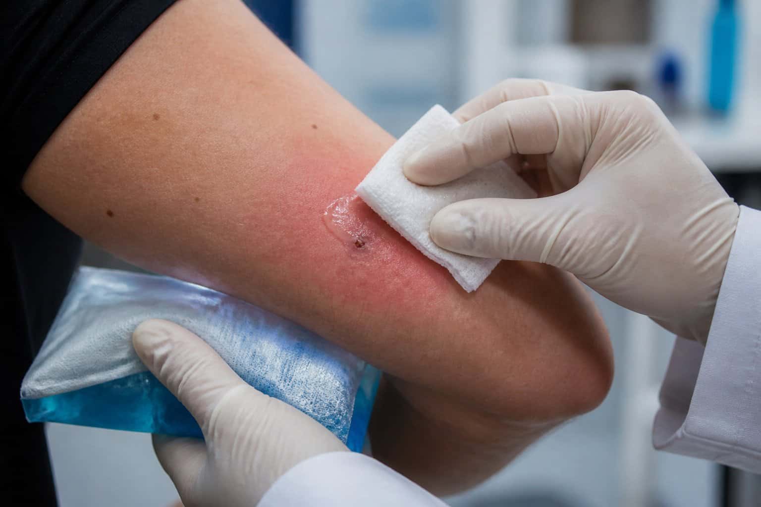 A medical professional treating a bee sting on a person's arm with a cold compress in a clinical setting.