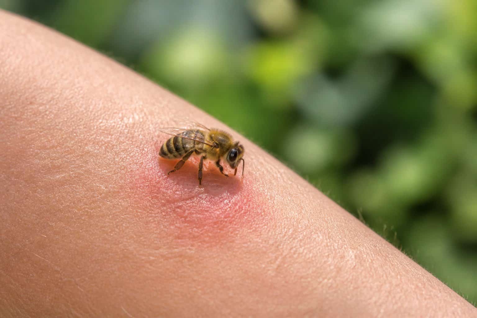 Close-up of a bee on a human arm with a small red spot showing a mild skin reaction.