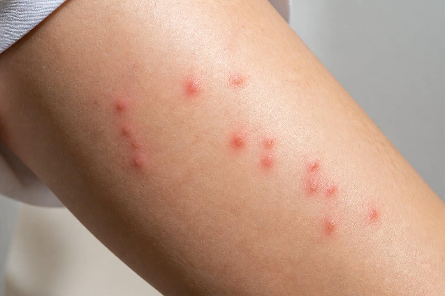 Close-up of human skin showing red, clustered bite marks typical of early bed bug bites.