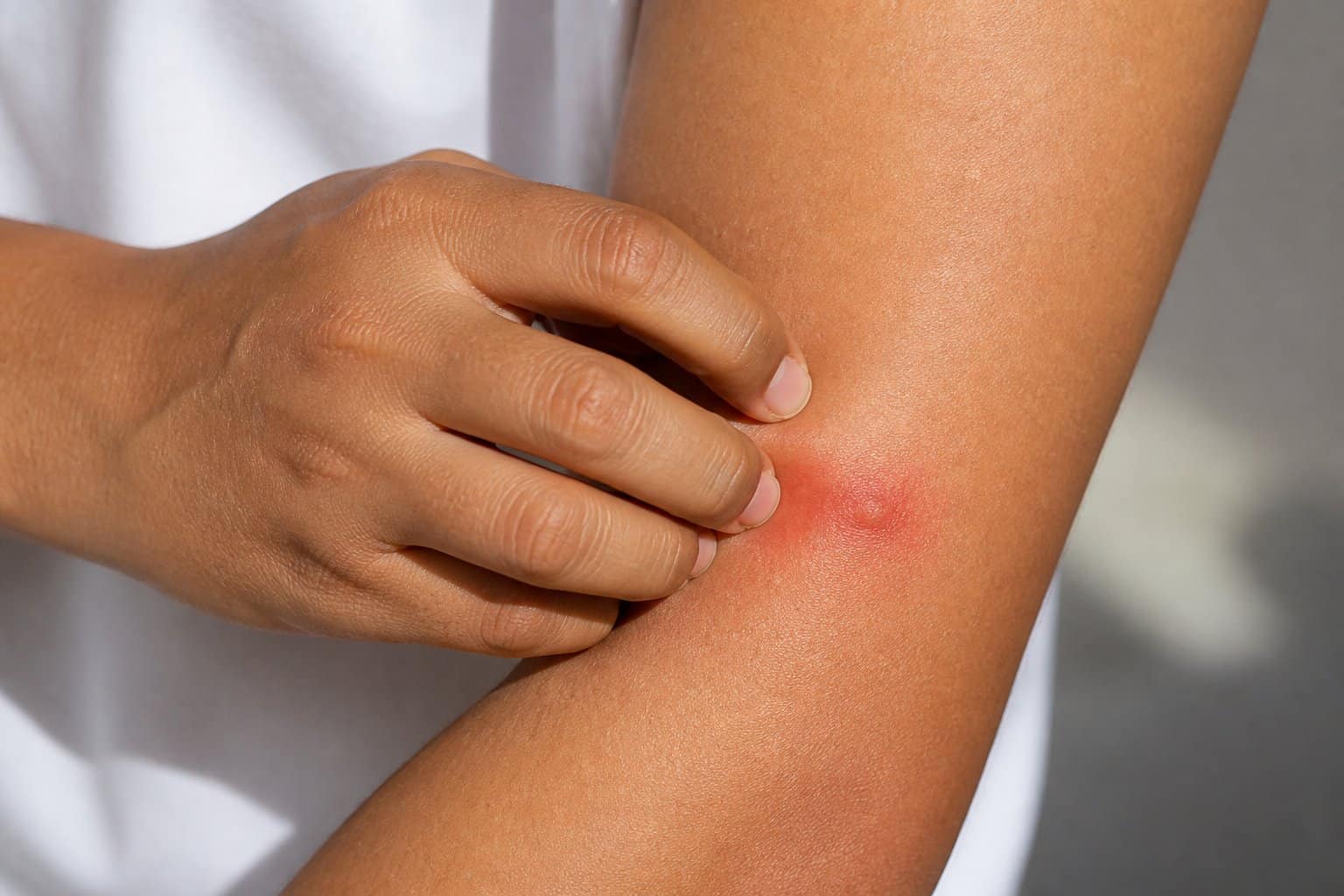 A person scratching a red itchy bump on their arm caused by a bed bug bite.