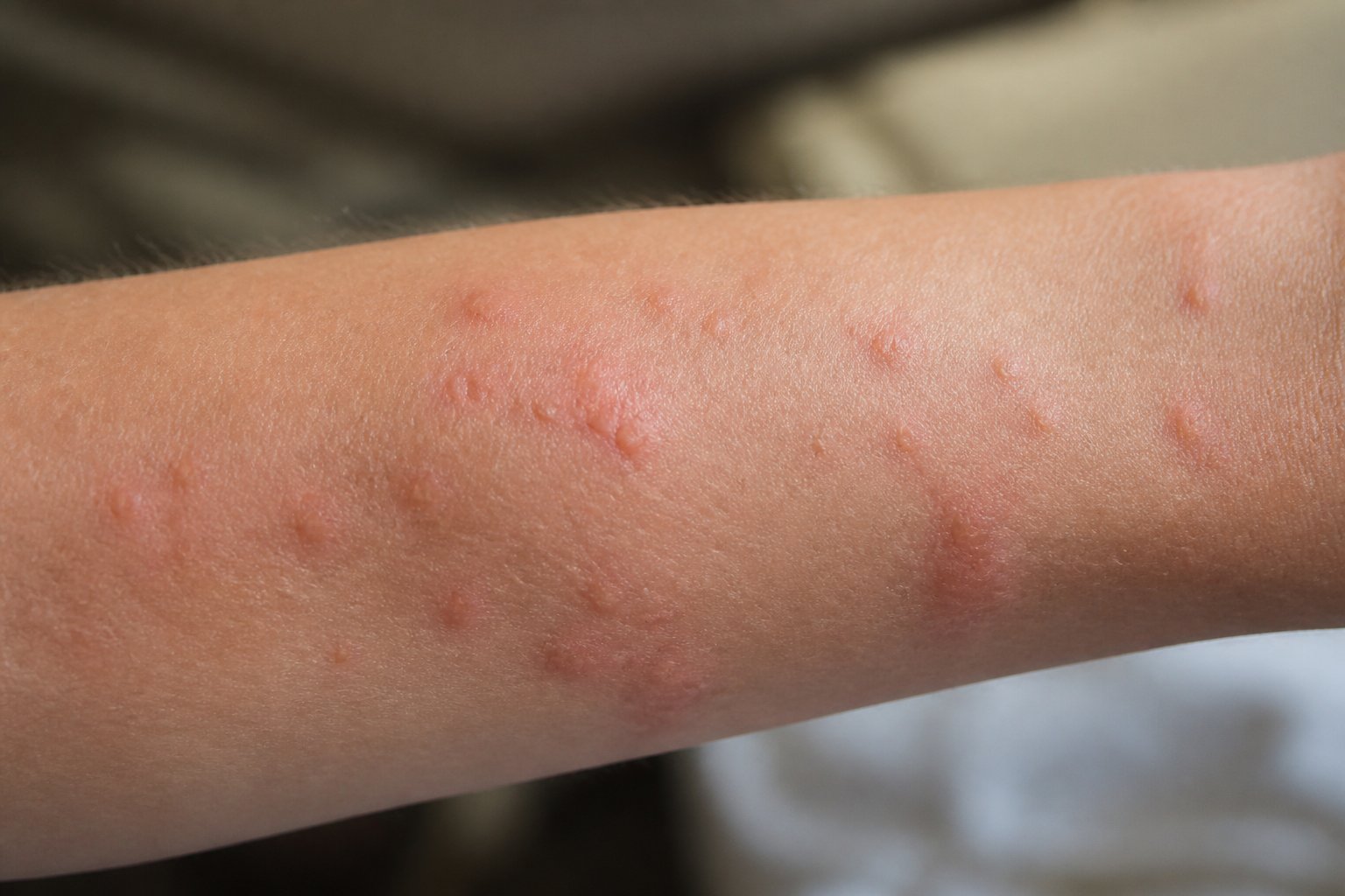 Bed Bugs Or Hives: How To Tell The Difference Bed Bugs Or Hives: How To Tell The Difference