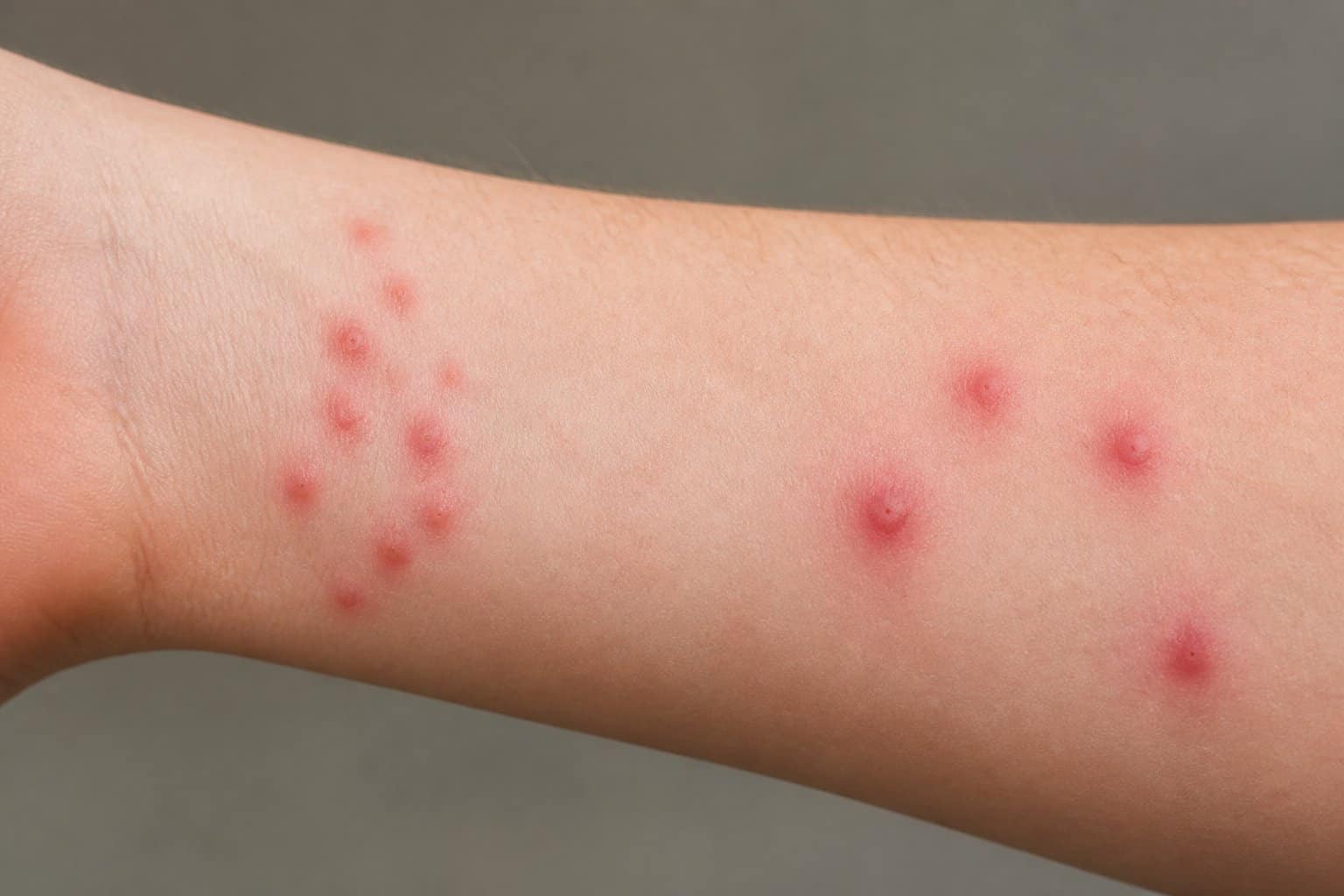 Close-up of a forearm showing red insect bites, with clustered bed bug bites on one side and isolated mosquito bites on the other.