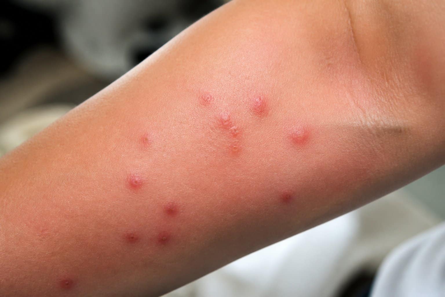 Close-up of a human arm with several fresh red bed bug bites clustered together on the skin.