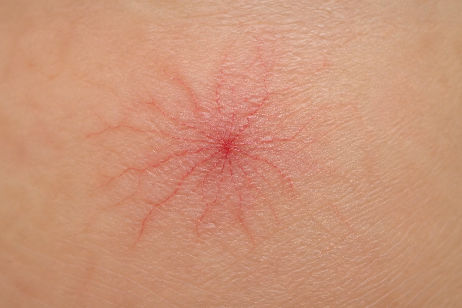 Spider Angioma Same As Telangiectasia? Key Differences Spider Angioma Same As Telangiectasia? Key Differences