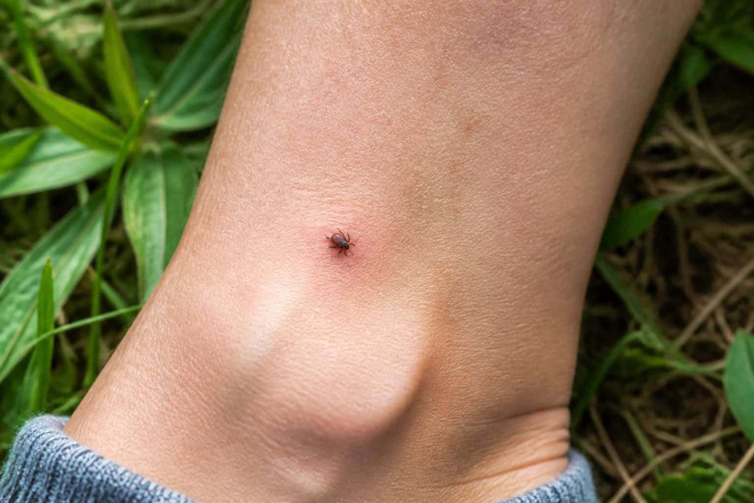A tick attached to a person's lower leg in a grassy outdoor setting.