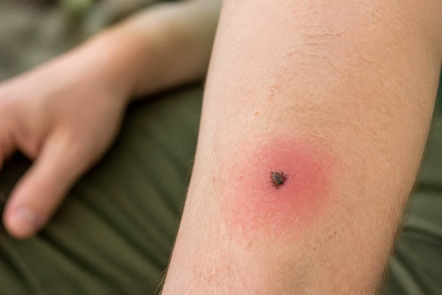 A close-up of a tick attached to an arm with mild redness and swelling around the bite.