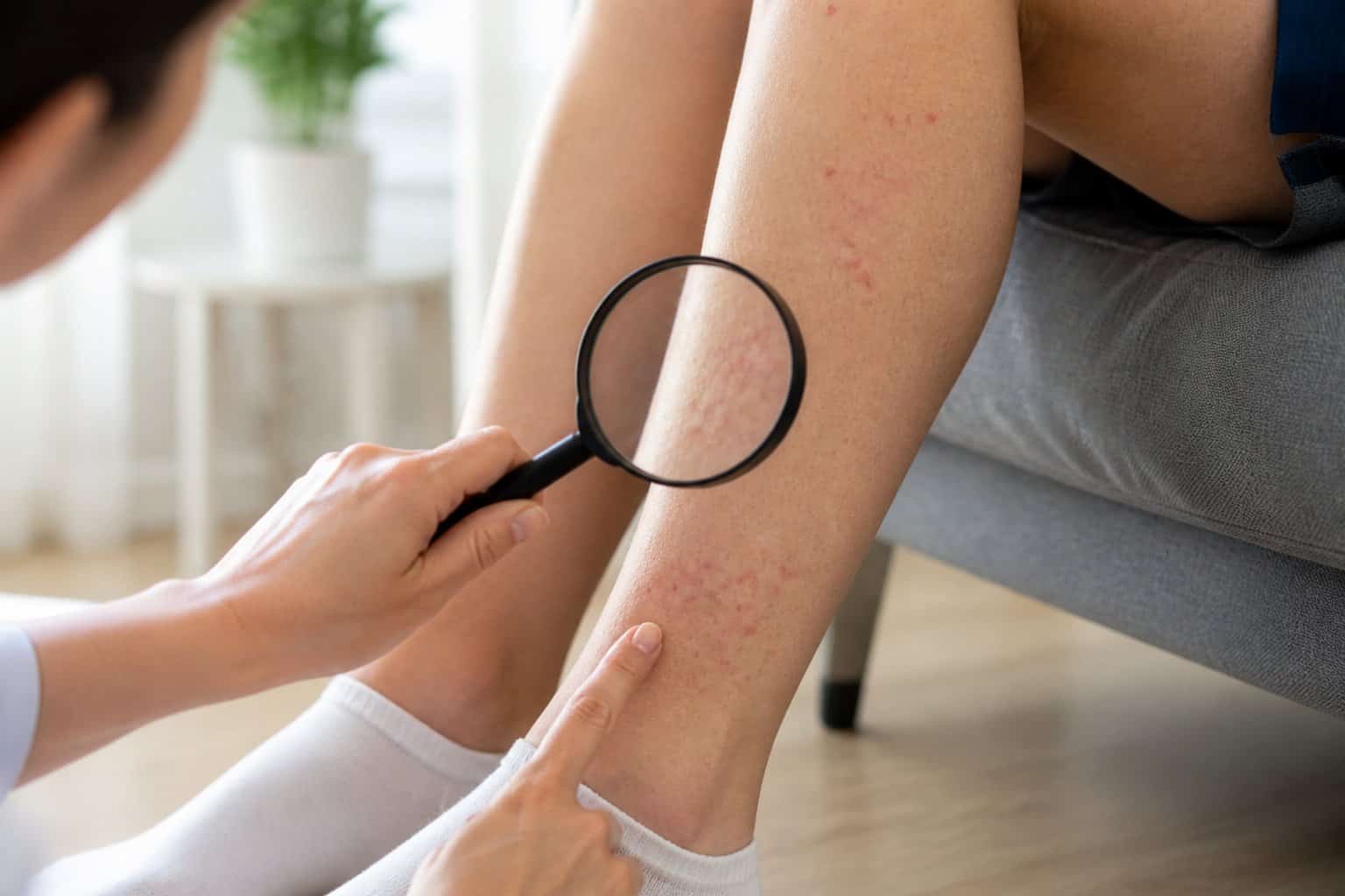 A person examines small red bite clusters on an adult’s lower legs and ankles.